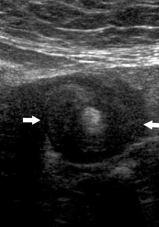 Sonographic Whirlpool Sign in Ovarian Torsion symptoms, history of associated pregnancy, and laboratory findings were obtained from the patients records.