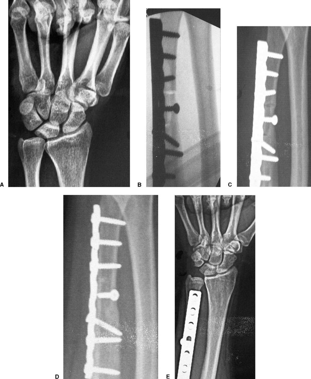 946 The Journal of Hand Surgery / Vol. 30A No. 5 September 2005 Figure 2. (A) Preoperative pronated grip view radiograph of a patient with ulnocarpal impaction.