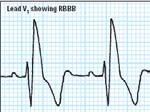 Bundle-branch blocks Understanding the 12-lead ECG, part II Most common electrocardiogram (ECG) abnormality Appears