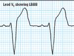 cause: ischemic heart disease 2 ight bundle-branch branch block (BBB) Impulse conduction to right ventricle is