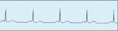 31 Anterior infarction Lateral-wall SEMI Anterior infarction erfused by the circumflex artery I II III av avl avf V1 V2 V3 V4 V5 V6 Muscular, contributes significantly to the heart s pumping ability