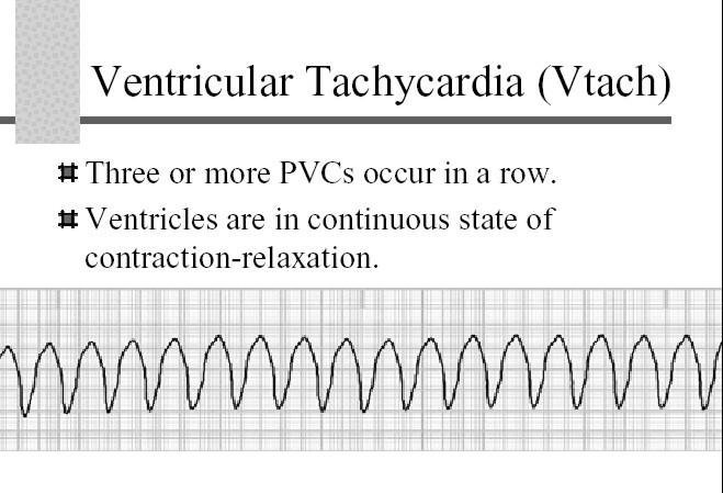 43 Ventricular tachycardia (V) apid rate, 100 to 250 beats per