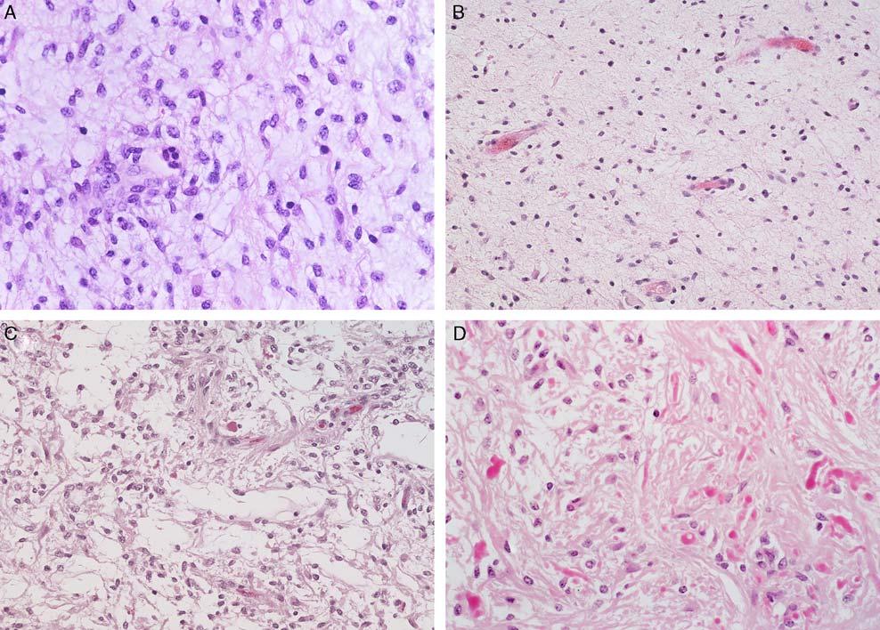 Am J Surg Pathol Volume 34, Number 12, December 2010 FIGURE 4. Maturation of a pilomyxoid astrocytoma. Shown are 4 images from 2 resections of a child with a midbrain tumor.