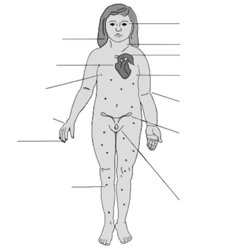Slov Pediatr 2012; 19 (suppl. 1) 7 TURNERJEV SINDROM Turnerjev sindrom je posledica nepravilnosti kromosoma X.