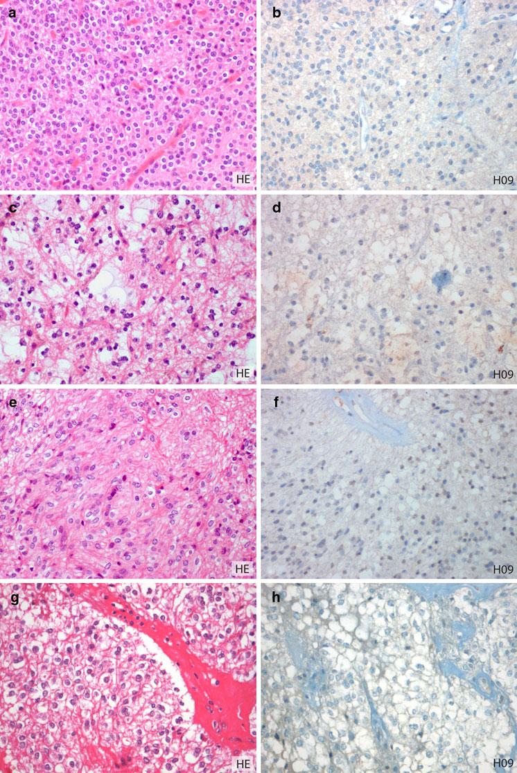 Fig. 3 H09 immunohistochemistry of nonoligodendroglioma clear cell brain tumors. Central neurocytoma with pronounced clear cell morphology (a) negative for H09 (b).