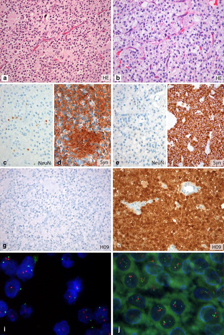 Fig. 4 H09 differentiates extraventricular neurocytoma from oligodendroglioma with neurocytic differentiation.