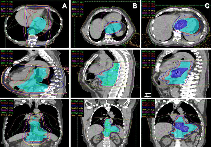 J Radiat Oncol (2012) 1:347 354 349 Fig. 1 Axial, sagittal, and coronal displays of 3D conformal, IMRT, and simultaneous integrated boost IMRT plans. All plans have 95 % coverage of PTV.
