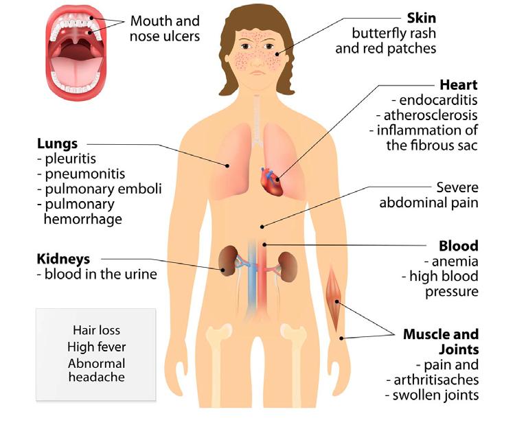Symptoms Systemic lupus erythematosus can