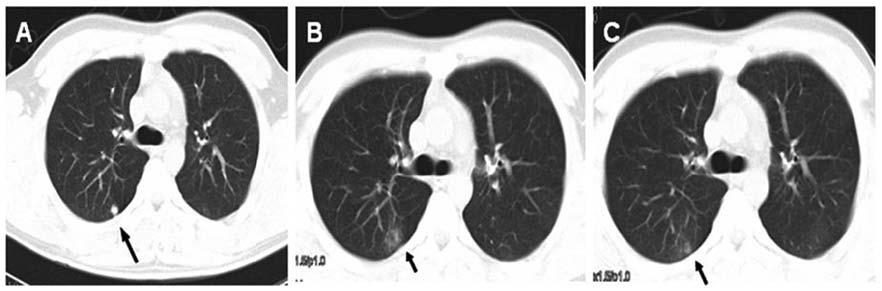 INTERNATIONAL JOURNAL OF ONCOLOGY 44: 1091-1098, 2014 1095 Figure 3. Radiation pneumonitis occurs 2 months after SRS treatment. Before SRS treatment (A).