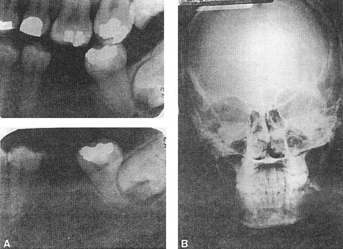 The patient presented with a complaint of pain in the left posterior maxilla. Clinical examination revealed drainage from the buccal sulcus around tooth no.