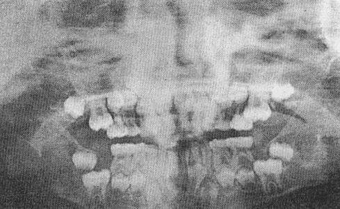 Buccal object rule. The radiographs above illustrate the buccal object rule. Bitewing and periapical films (A) show an impacted third molar on the left side.