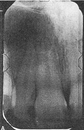 with a mucous retention phenomenon. The apical view (B) shows a radiolucent area apical to the root of tooth no. 2. The sinus floor is el evated but intact.