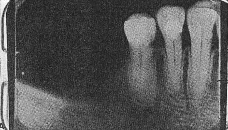 has sustained a fracture (A and C). More often than not, unilateral fracture of the condyle is associated with a fracture of the opposite side of the body of the mandible.
