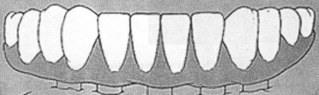 126. What is the fixed high-water prosthesis on an edentulous arch?
