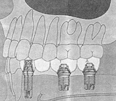 critical. In addition, more fixtures are necessary to support the prosthesis (minimum of 6). 131. Should an implant prosthesis be considered in partially edentulous patients?