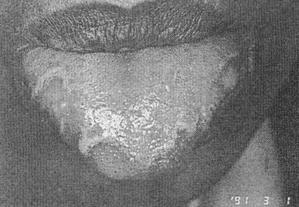 Benign migratory glossitis. 23. What predisposes to the formation of a hairy tongue?