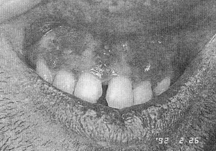 obstruction. In such a case, the mucocele is a true cyst, because the lining is the epithelium of the duct. 53. What is the etiology of necrotizing sialometaplasia?