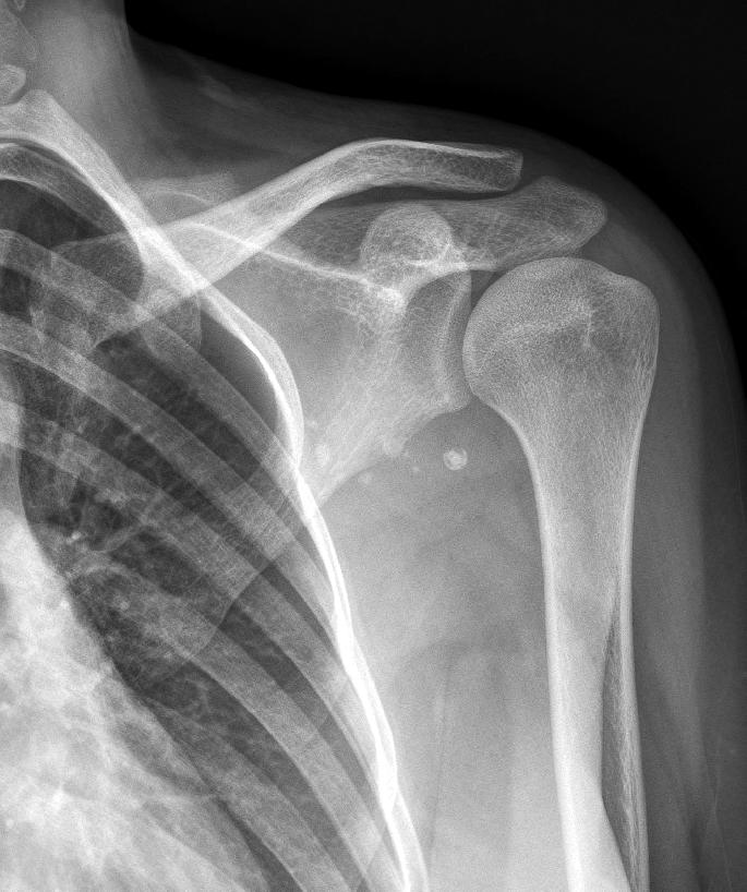 Clinics in Shoulder and Elbow Vol. 17, No. 4, December, 2014 area, and a soft mass was detected by palpation, which had an undefined border and an approximate size of 7 cm by 10 cm.