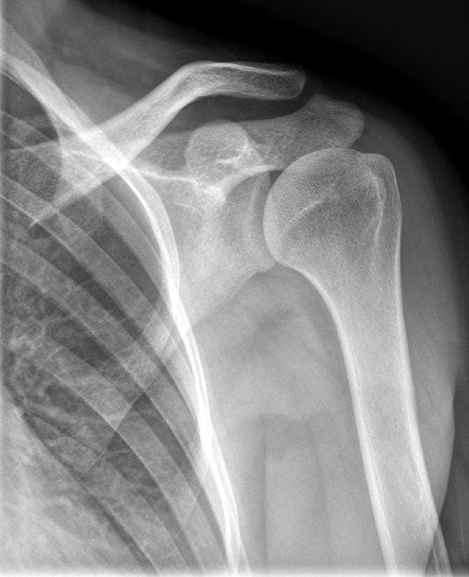 The tumor was situated in the front of the subscapularis recess and was infiltrating into the intramuscular portion of the subscapularis.