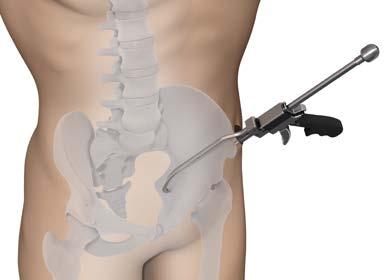 Collinear Reduction Clamp. For minimally invasive fracture reduction. The Collinear Reduction Clamp assists in achieving and maintaining fracture reduction in minimally invasive techniques.