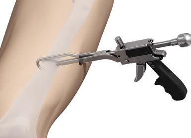754 Bone Hook-shape Arm, 206 mm 398.