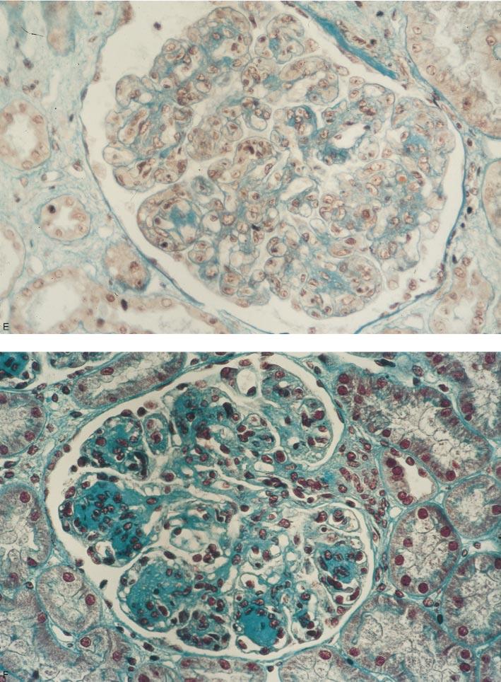 Nephrology Forum: Cryoglobulinemic GN 653 Fig. 1. Continued. granular staining for IgM and IgG in the capillary wall subendothelium, with no intraluminal staining (Fig. 2C).