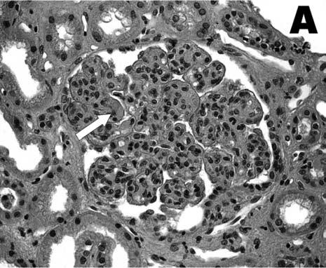 54 G. Garini, L. Allegri, F. Iannuzzella, A. Vaglio, C. Buzio A) B) Figure 2. HCV-associated cryoglobulinemic MPGN. (A) Broad proliferation of mesangial cells with monocyte infiltration.