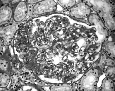 HCV-related glomerulonephritis 55 presence of large subendothelial immune complex deposits. Immunosuppressive treatment was started with corticosteroids (methylprednisolone pulses of 1.