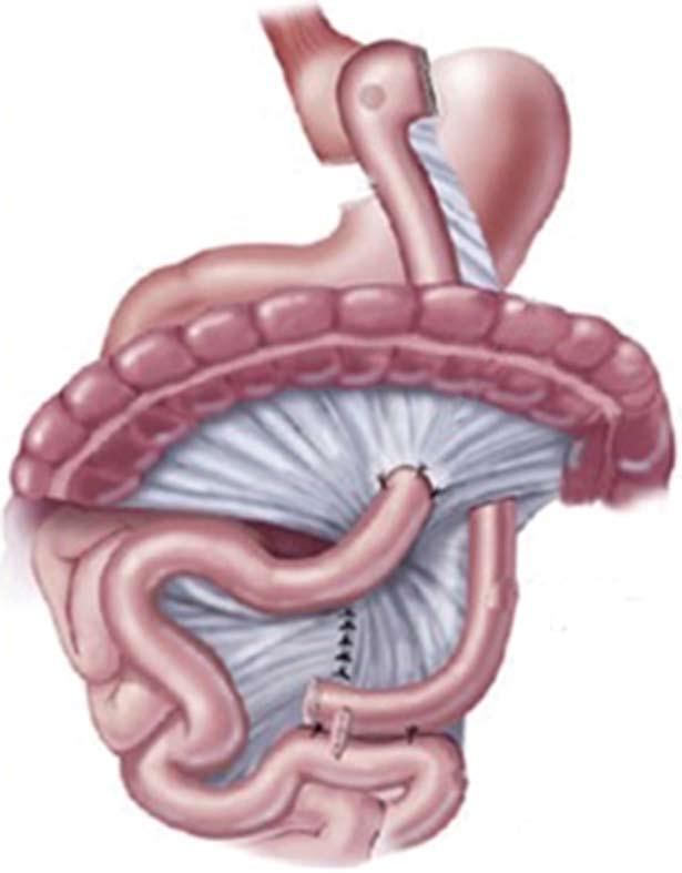 Transverse mesocoion D Biliopancreatic limb Alimentary limb Biliopancreatic limb Common channel Common channel Roux-en-Y gastric bypass Billopancreatic diversion with duodenal switch Figure 1 The