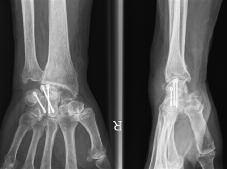 324 L. DE SMET, P. DEPREZ, J. DUERINCKX, I. DEGREEF MATERIALS AND METHODS Between November 1998 and May 2007, 35 patients underwent four-corner arthrodesis at the wrist.