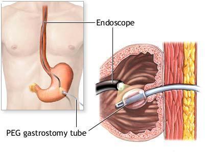PEG = percutaneous endoscopic gastrostomy (5, 6, 26, 27) Permite un control rapid al greturilor si varsaturilor intractabile. Procedura mai putin invaziva decat o gastrostomie deschisa.