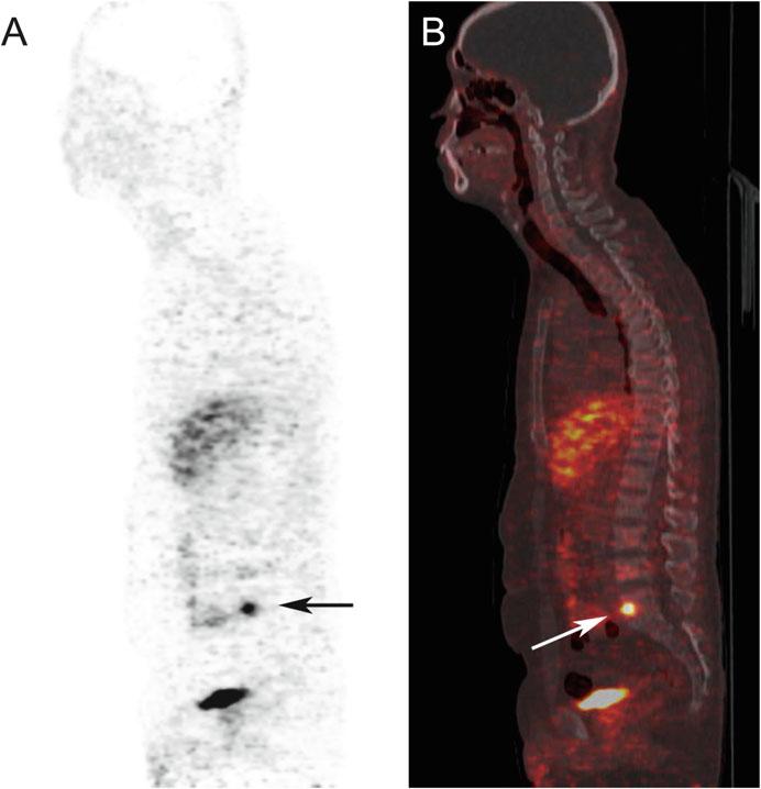 308 Y. Nakamoto et al. Fig. 23.2 A 54-year-old man with tumor-induced osteomalacia. Sagittal DOTATOC PET (a) and fused (b) images are shown.