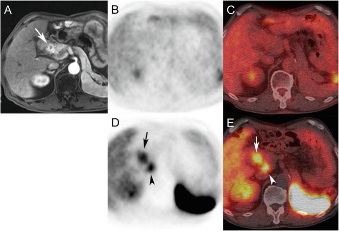 23 Clinical Efficacy of PET/CT Using 68 Ga-DOTATOC for Diagnostic Imaging 309 Fig. 23.3 A 76-year-old man with a hypervascular pancreatic tumor.