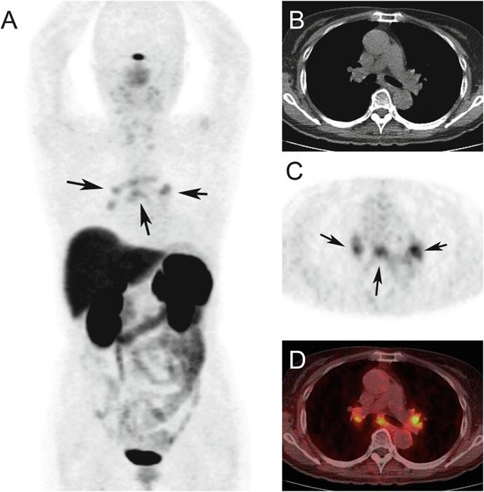 310 Y. Nakamoto et al. sarcoidosis was investigated in one study [20].