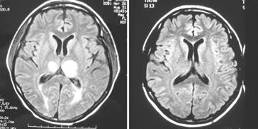 Original A. Bortoluzzi, M. Padovan, I. Farina et al. Figure 1 - Case report of a 31-year-old patient with an ongoing acute confusional state occurred after a recent HELLP syndrome.