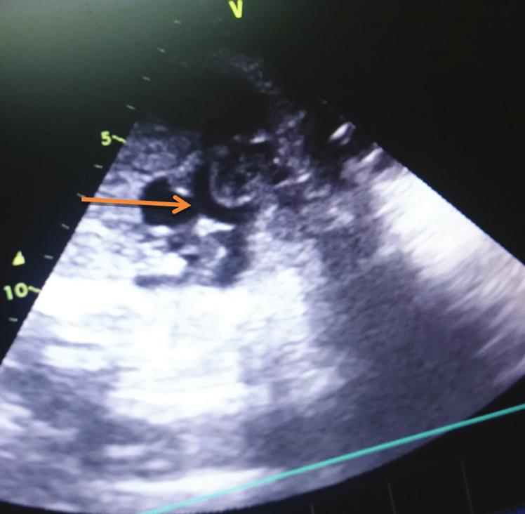 Observer variation. 4. Cardiac malpositions may be missed. CONCLUSION Fetal echo evaluation is possible as a routine screening. High-risk maternal and fetal cases should undergo fetal echo evaluation.