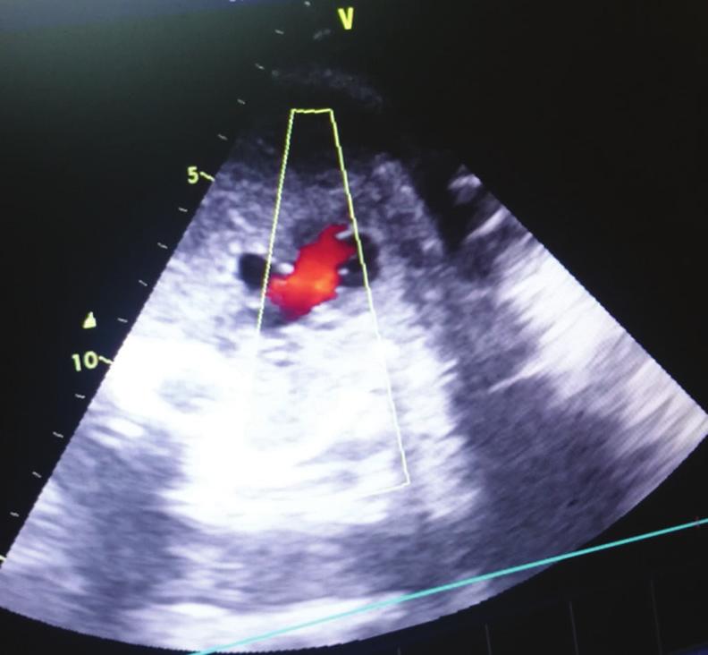 4/1000 Figure 6: Fetal echocardiogram showing color flow image of tetralogy of Fallot showing large malaligned ventricular septal defect with right to left shunt according to our study and correlates