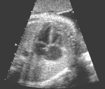 Heart and Lungs Normal Sonographic Anatomy THORAX Axial and coronal sections demonstrate integrity of thorax, fetal breathing movements, and overall size and shape.