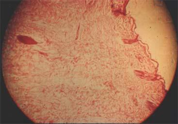 The epidermis is almost entirely dehydrated and soaling. The upper layer of the dermis shows slight thermal coagulation.