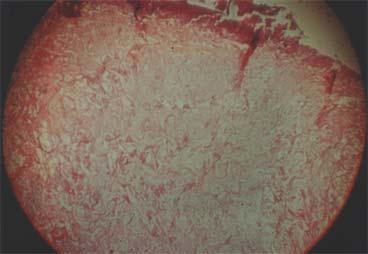 The framework of the collagen fibers shows evidence of some edema.
