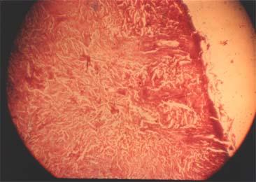 There is active epithelial regeneration and there is still some superficial debridement of the upper layer of the dermis.