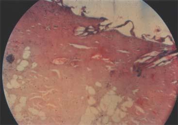 Histopathological changes 1 hour after thermal burn: The epidermis is almost entirely dissected from the underlying dermis. The upper layers of the dermis definitely stain darker.
