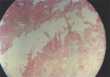 The stratum germinativum and granulosum show considerable damage due to dehydration.