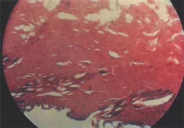 The upper layers of the dermis are thermally coagulated and tend to dissect in a large eschar from the deeper layers of the dermis where a marked inflammatory reaction is present.