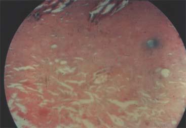 The numerous fragments of amorphous material arising from the thermally damaged dermis are invaded by an abundance of leukocytes.