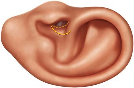 8 External Ear Canal Surgery 31 Fig. 8.
