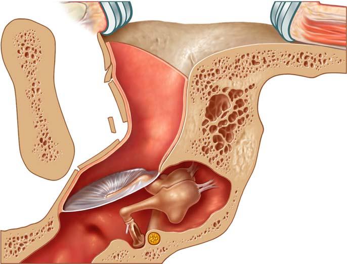 Fractures of the posterior wall are often associated with middle ear, inner ear or facial