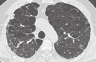 IMAGING IN PULMONARY FIBROSIS n 21 (a) (b) (using criteria similar to those found in Table 2) in 27 cases correlating to a sensitivity of only 37% (15).