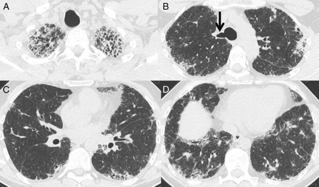 Figure 1 A-D, Multiple axial images from noncontrast chest CT scan show upper and peripheral predominant pulmonary fibrosis scored as inconsistent with usual interstitial pneumonitis (UIP) based on