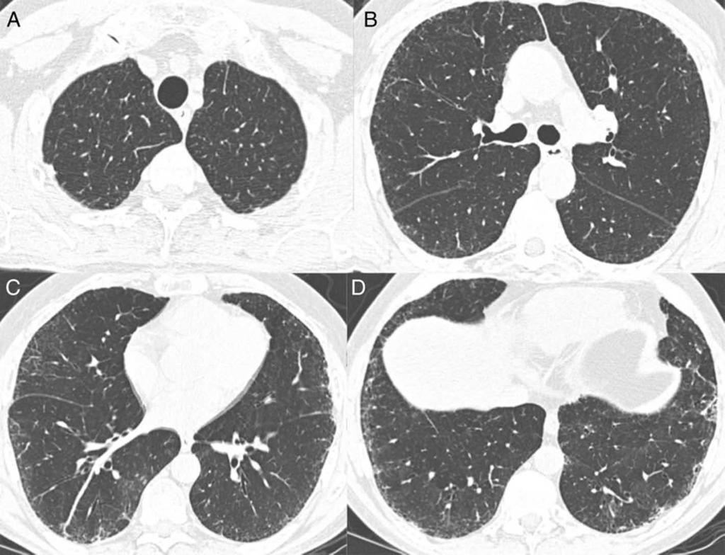 Figure 3 A-D, Multiple axial images from noncontrast chest CT scan show peripheral and basilar predominant pulmonary fibrosis without subpleural honeycombing. This CT scan was scored as probable UIP.